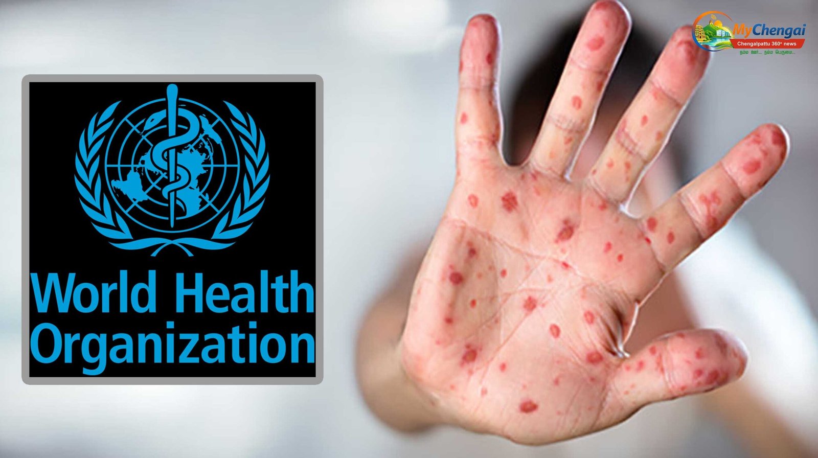 Measles Outbreak
