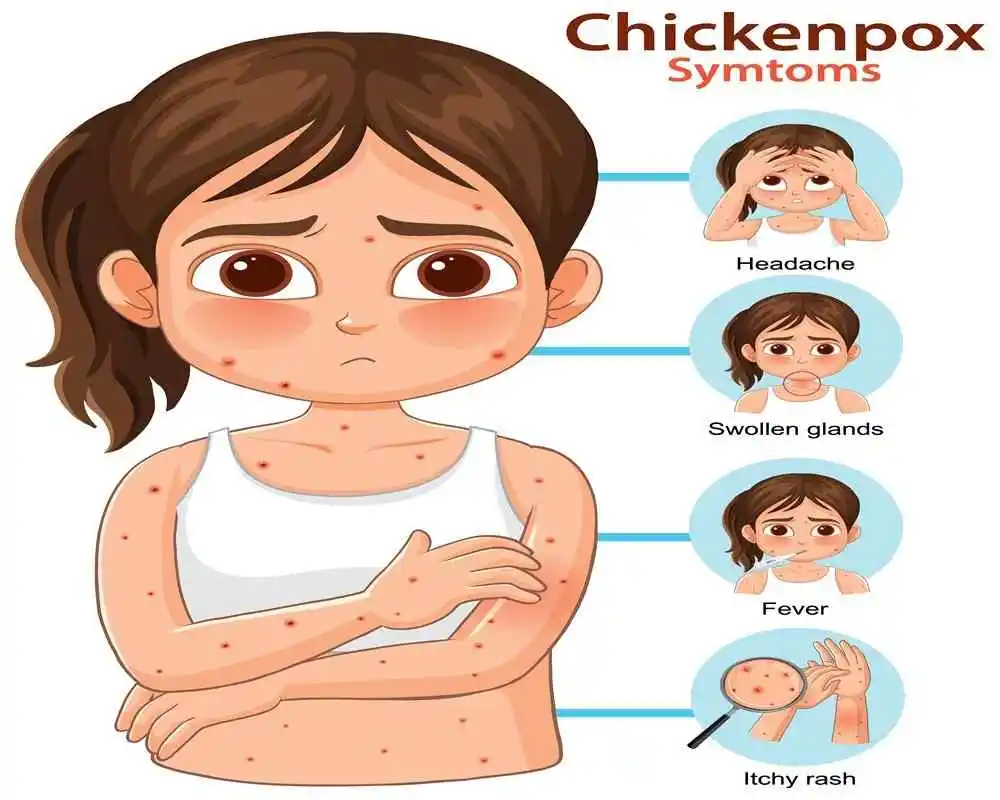 காஞ்சிபுரத்தில் வேகமாக பரவும் சின்னம்மை:  மருத்துவர்களின் முக்கிய அறிவுரை